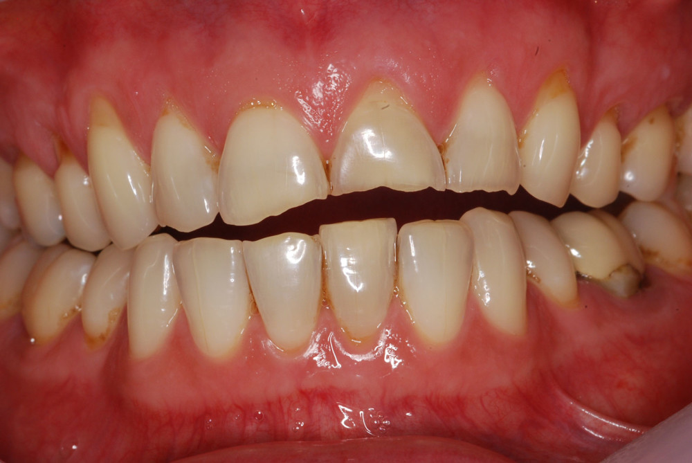Tooth surface loss and wear