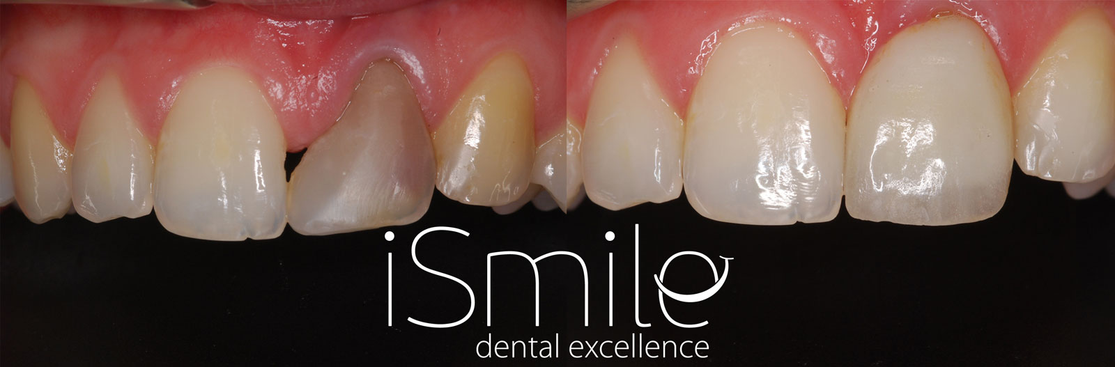 Smile makeover with bleaching, gum sculpting and porcelain veneer